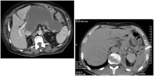 Percutaneous Drain for Abdominal Abscess (PCD)