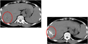 Radio-Frequency Ablation of Tumor